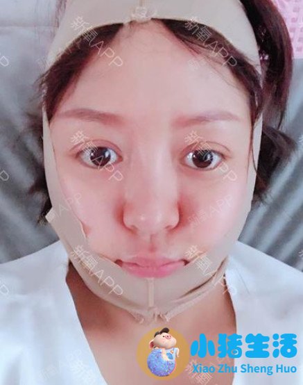 面部吸脂1年效果怎么样