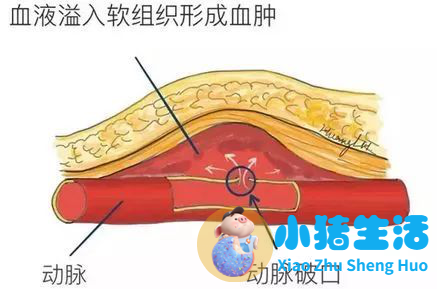 超声引导下穿刺注射无水酒精联合置引流