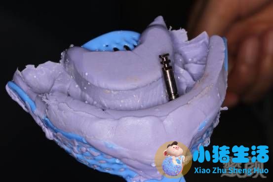种植牙术后的注意事项