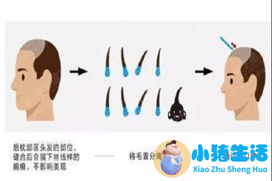 ptt毛发种植有风险吗