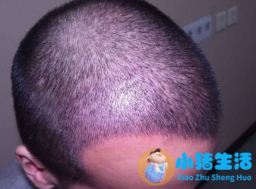 ptt毛发种植有风险吗