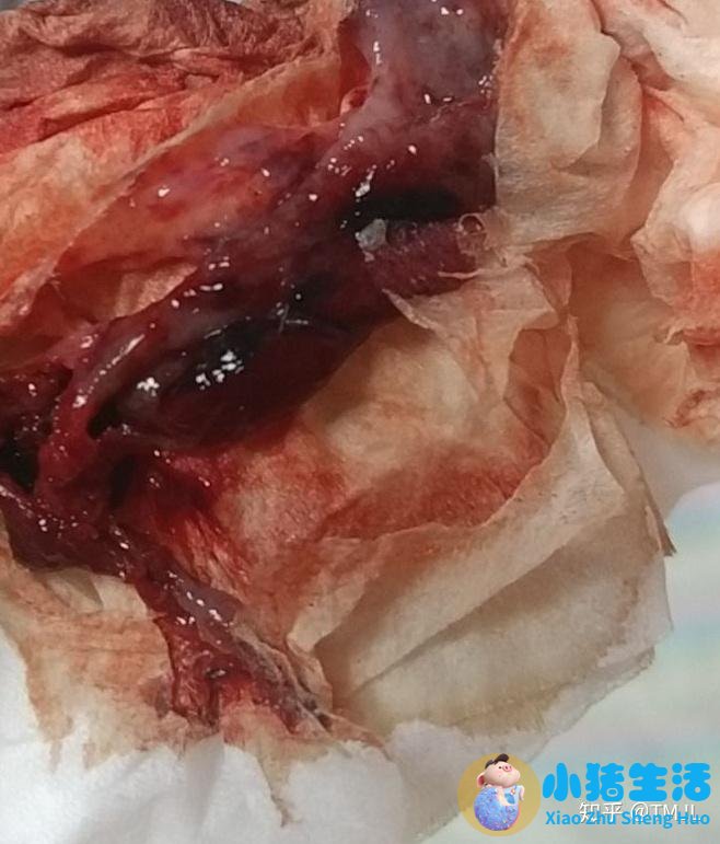 初次怀孕药流还是人流