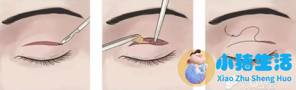 邹笑寒做双眼皮怎么样