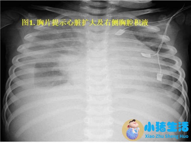 缩窄性心包炎 中医治疗