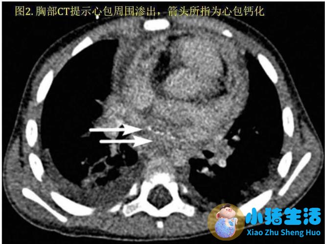 缩窄性心包炎 中医治疗