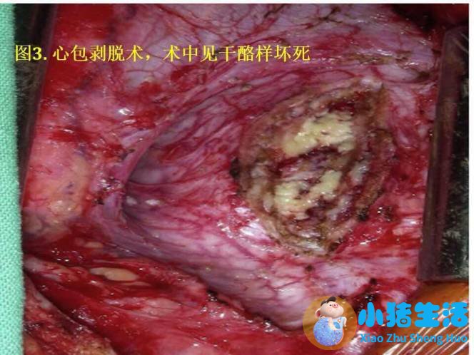 缩窄性心包炎 中医治疗