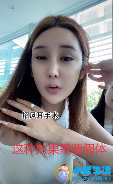 招风耳整形案例