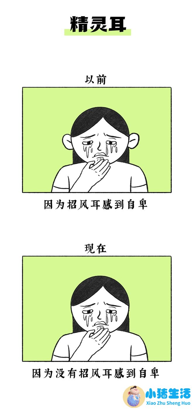 招风耳整形案例
