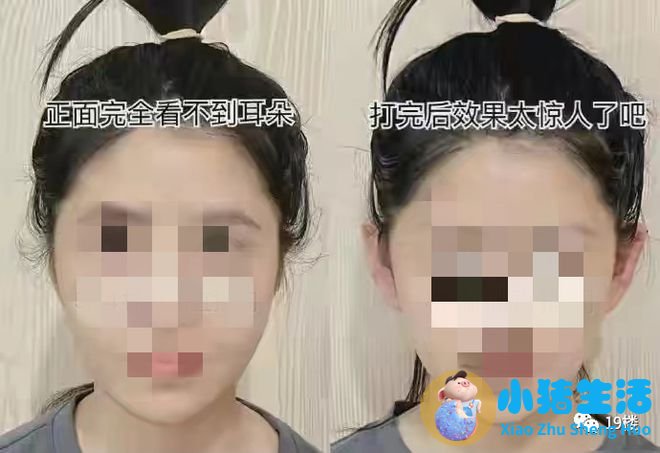 招风耳整形案例