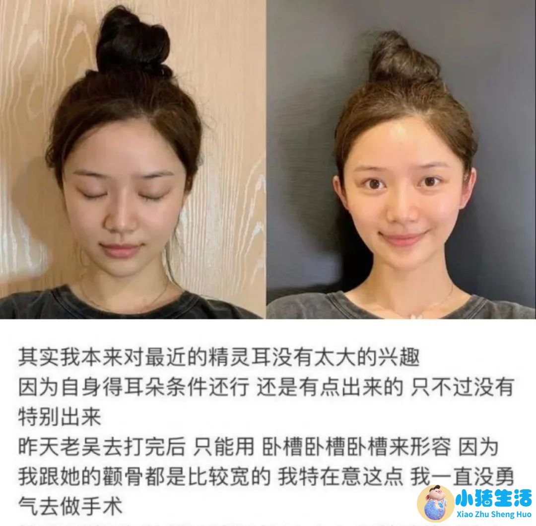 招风耳整形案例