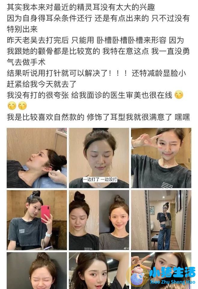 招风耳整形案例