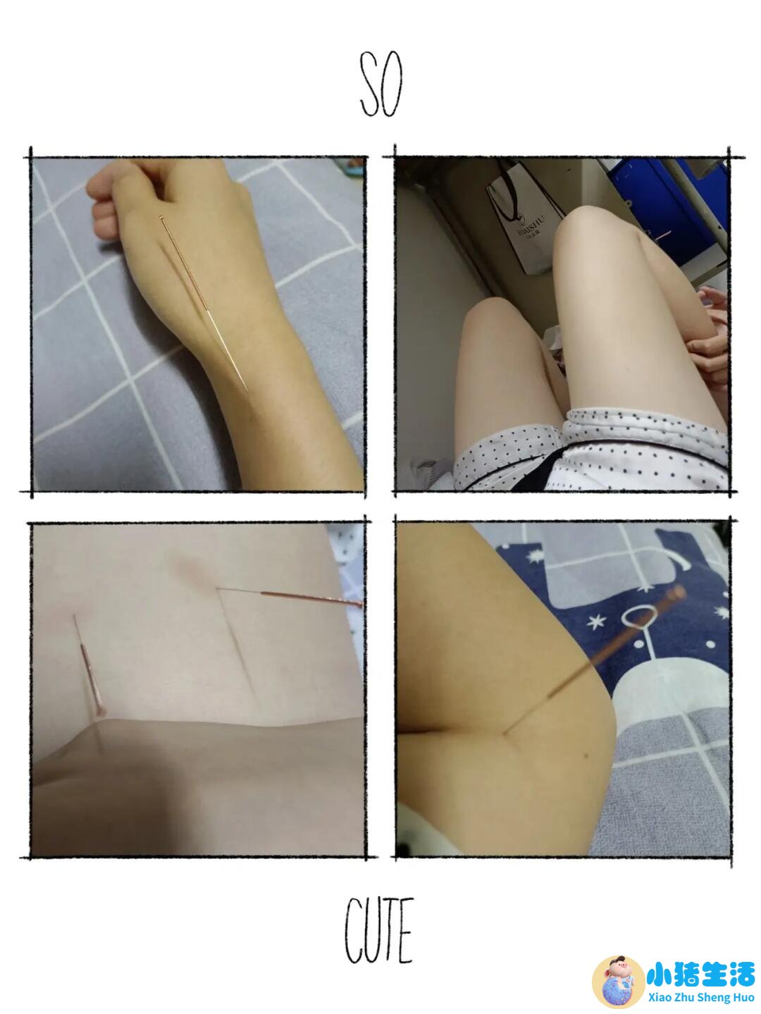 针灸局部减肥