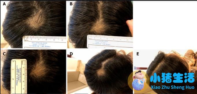 头发能不能克隆人