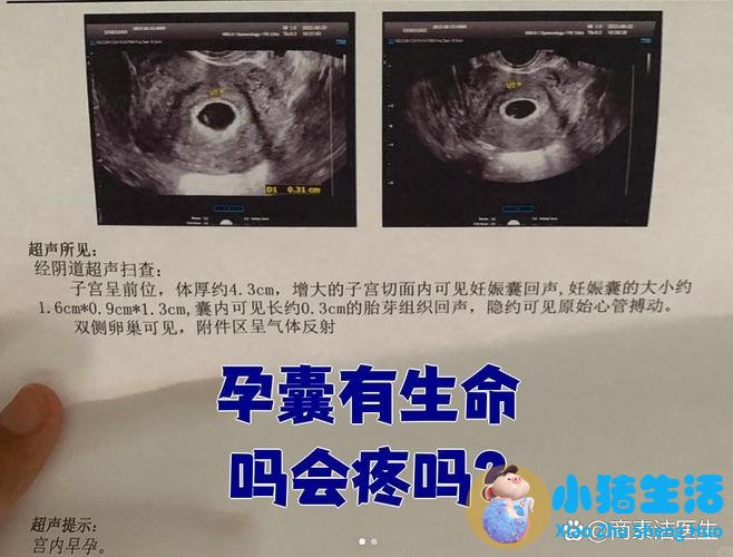 怀孕50天孕囊正常大小 每日例题|妇产科高级职称每日一考点