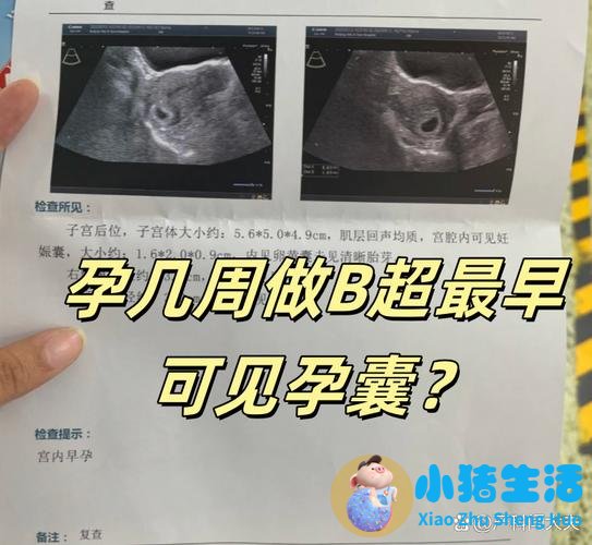 怀孕50天孕囊正常大小