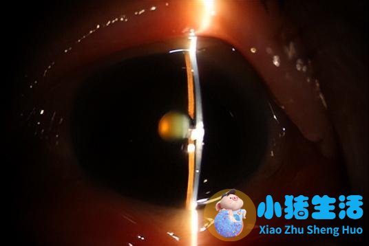 白内障术前（上）、术后（下）对比