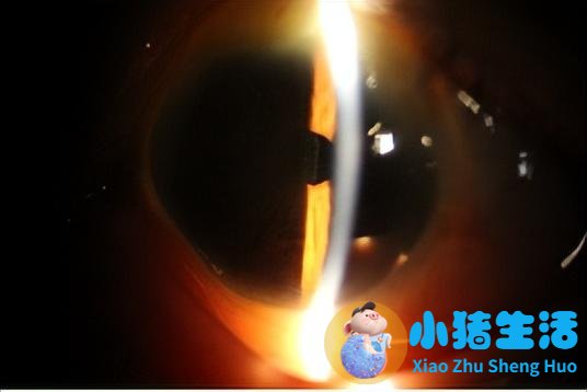 白内障术前（上）、术后（下）对比
