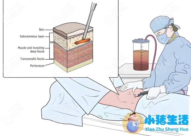 吸脂减肥之全身吸脂手术多少钱？