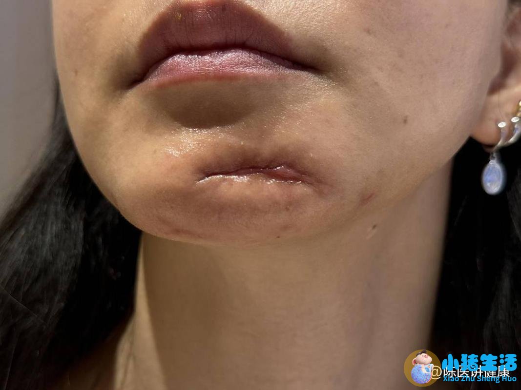 女子在徐州予美医美整容后下巴竟烂出一