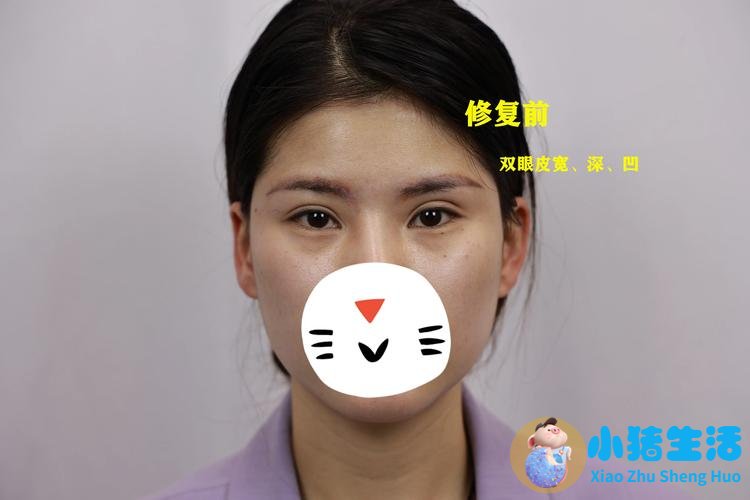 南京双眼皮面诊实录｜被医生劝别做大宽