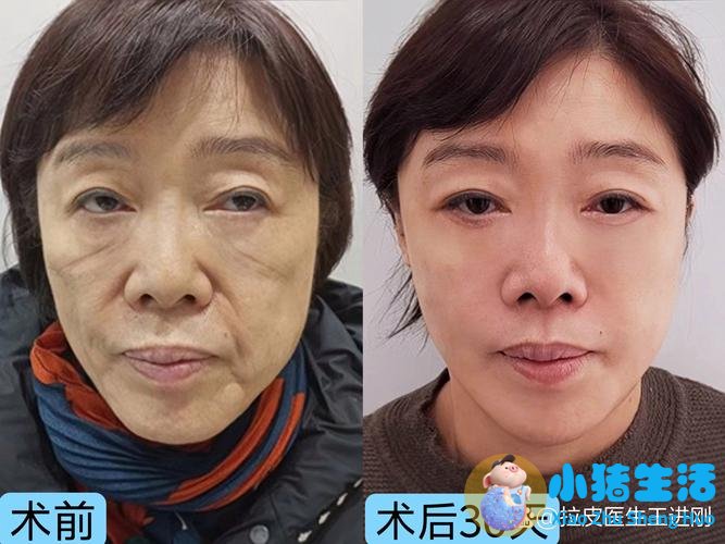4000例面部埋线提升之后，一位医生的技术