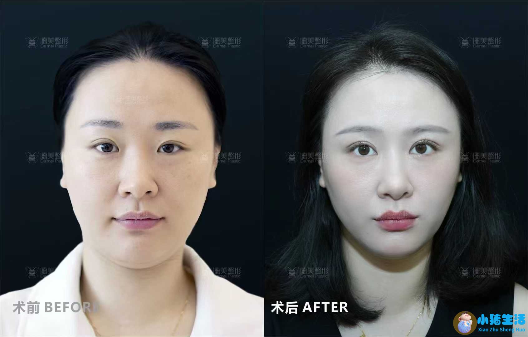 悦美网整形案例