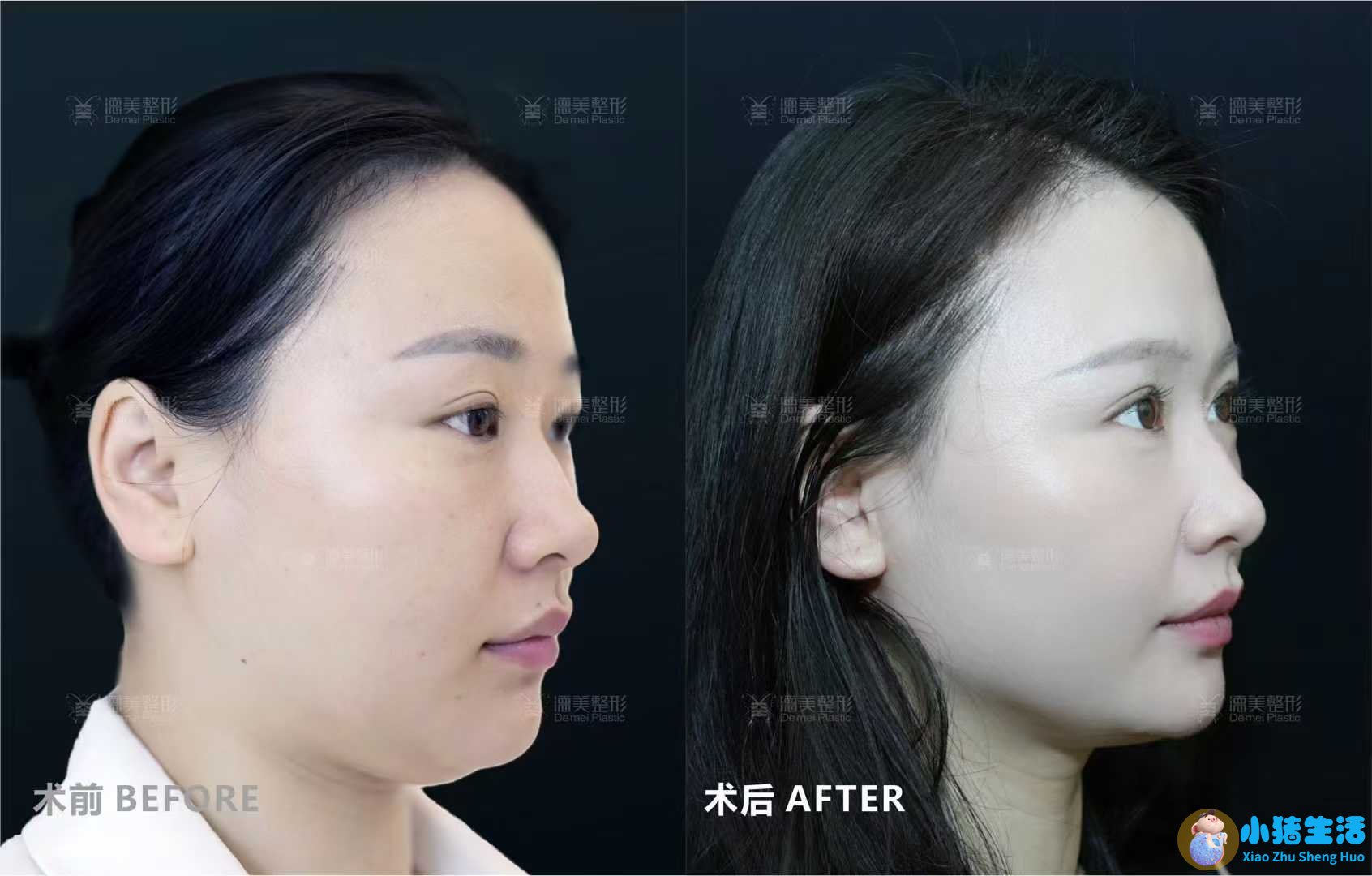 悦美网整形案例