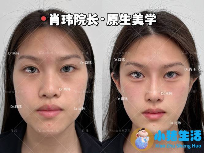 鼻整形案例