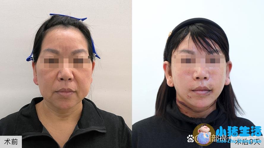 颌面整形真实误区！不是脸越小越好看，