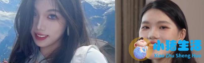 正颌手术被做反女孩:已达成和解,希望回归正常生活