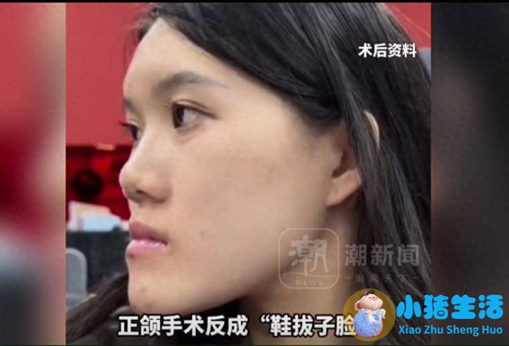颧骨整形失败案例怎样改善