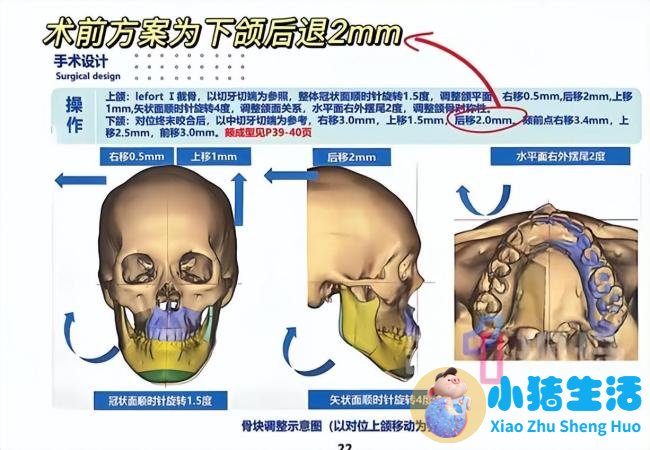 正颌手术被做反女孩:已达成和解,希望回归正常生活