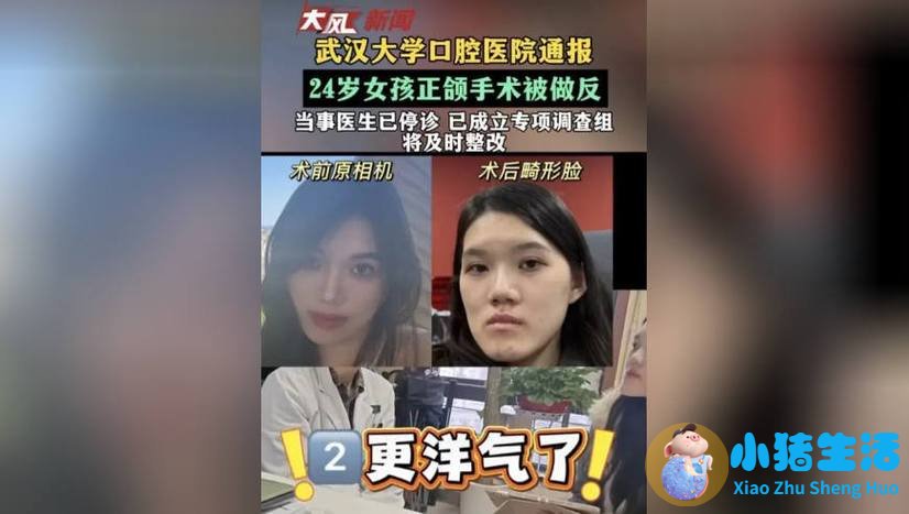 颧骨整形失败案例怎样改善