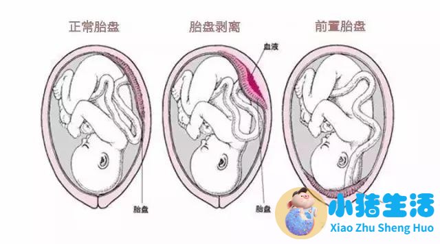 <strong>孕期产检不偷懒，关于前置胎盘的危害！</strong>