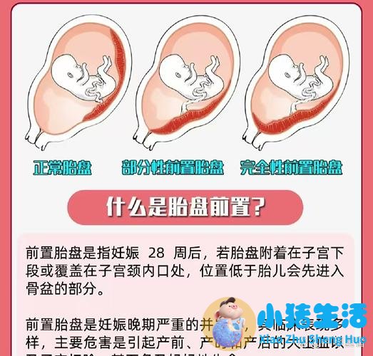 臀位快生时有什么预兆