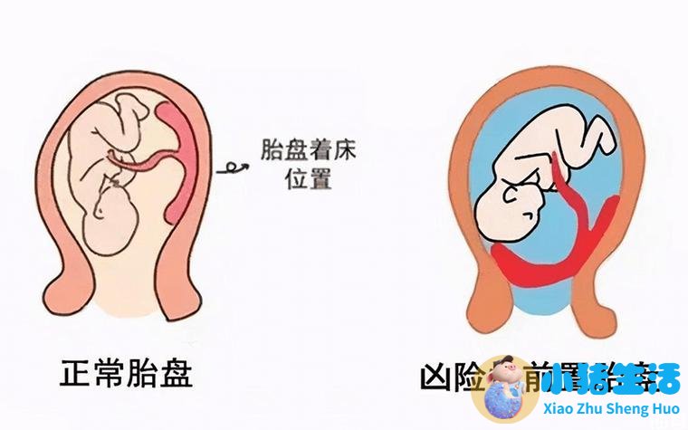 臀位快生时有什么预兆