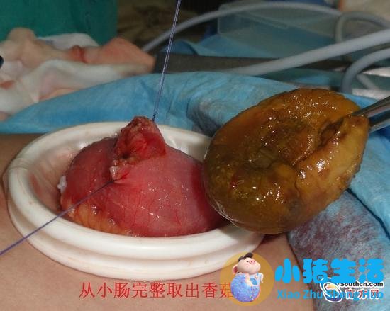 脸部抽脂后皮肤会松吗