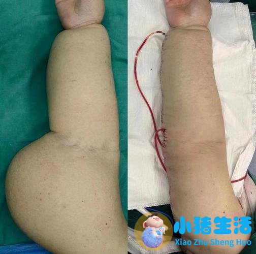 脸部抽脂后皮肤会松吗