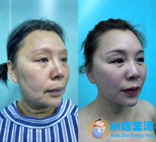 脸部抽脂后皮肤会松吗