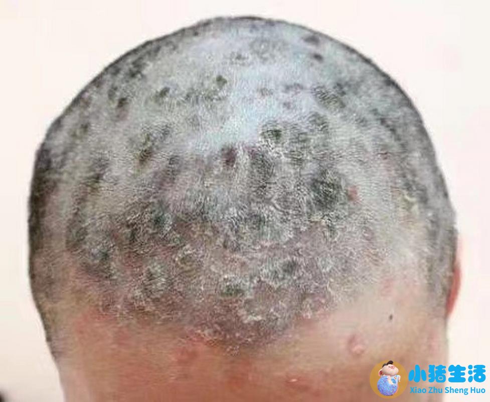 老有头皮屑是什么原因