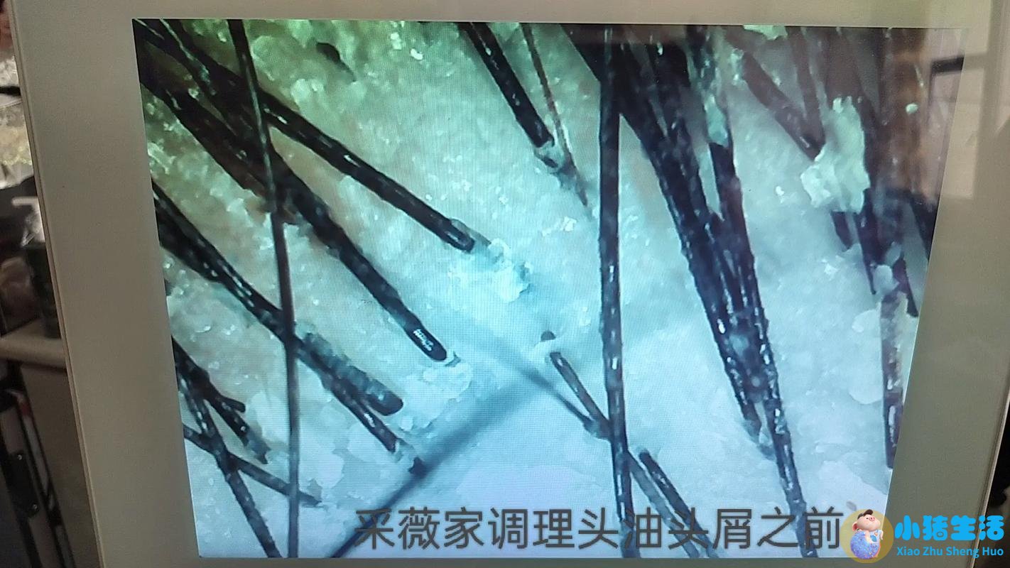 <strong>染发后头皮屑多是什么原因 染发后有头皮</strong>