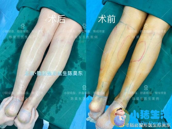 专业整形瘦腿术帮你轻松瘦小腿