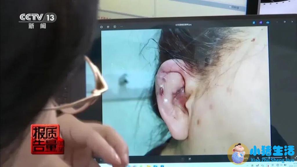 荆州中心医院整形董洁案例