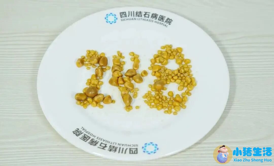 胆结石术后每天需要运动多久
