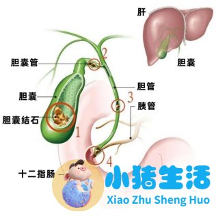 胆结石术后每天需要运动多久