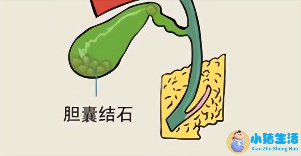 胆结石术后每天需要运动多久