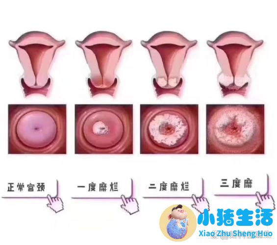 宫颈糜烂二度会影响怀孕么