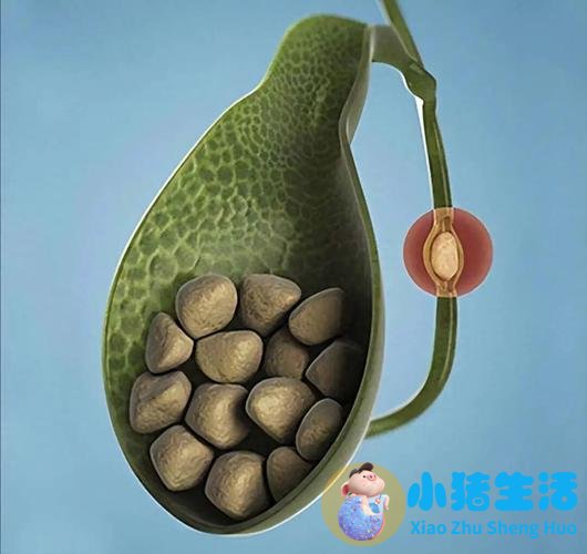 胆结石术后每天需要运动多久