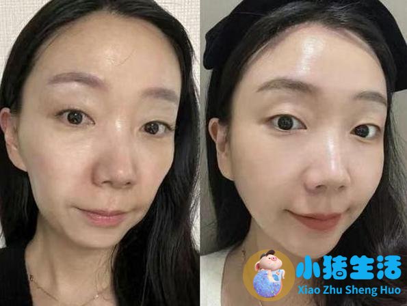 德彩玻尿酸