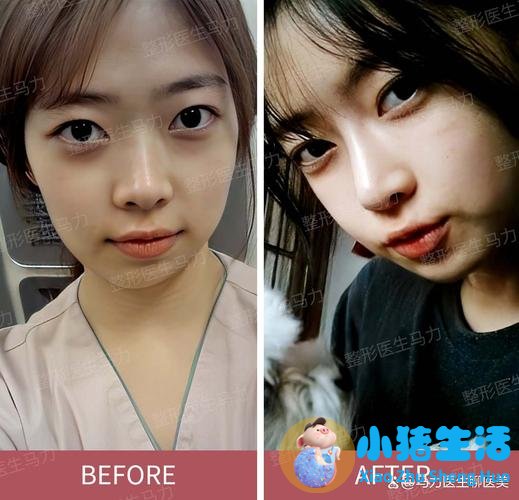 济南玻尿酸注射隆鼻价格